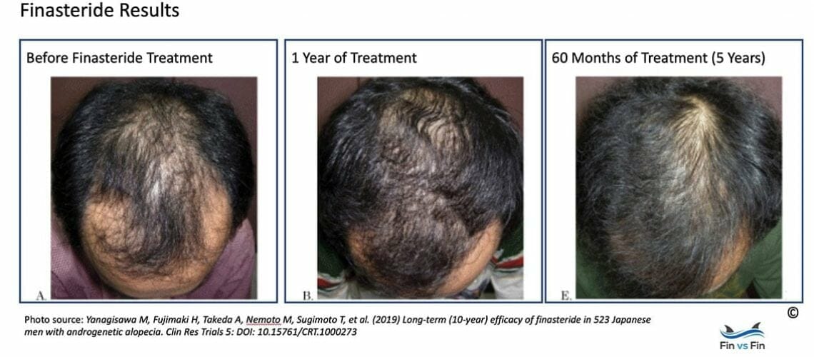 Hair Loss 101: What Every Man Should Know Before Going Bald