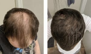 Individual bending forward showing scalp before and after hair loss treatment.