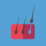 Hair Loss