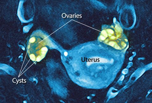 How to Test for PCOS: What’s the Most Accurate PCOS Test Online?