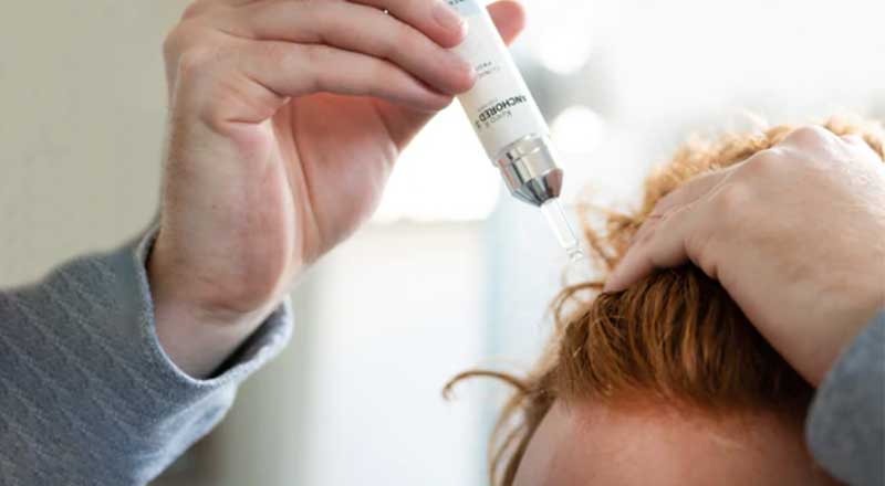 lady applying hair loss treatment product