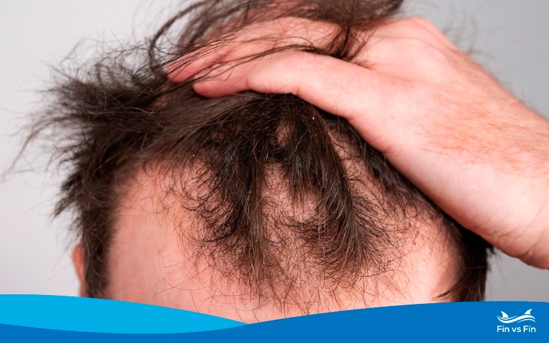 prevent hair loss