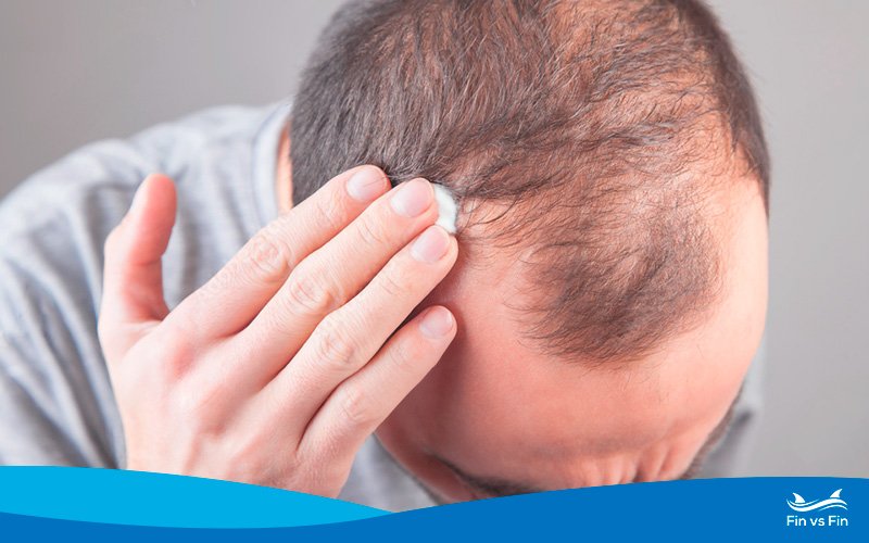 tretinoin for hair loss